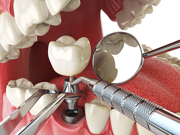 Best Emergency Dentist for Lost Fillings or Crowns in Topton, PA
